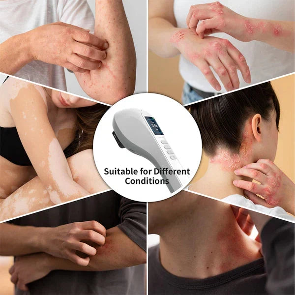 Luz de terapia UVB de 308 nm: tres pantallas de lámpara independientes, inalámbrica y portátil