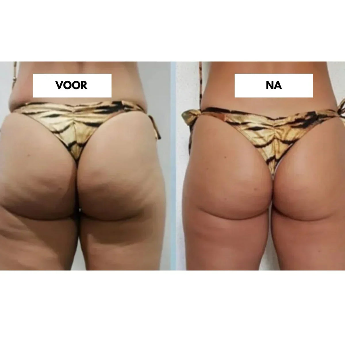 CelluLift Anti-Cellulite-Vakuummassagegerät für straffere Haut