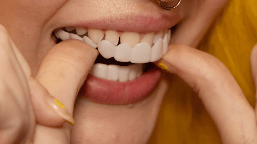 Facettes dentaires amovibles NovaBright pour dents supérieures et inférieures — sourire naturel instantané