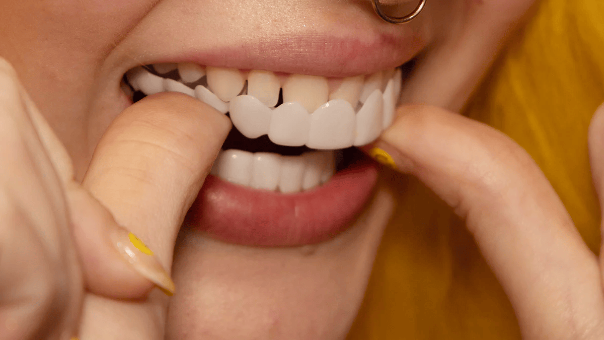 Facettes dentaires amovibles NovaBright pour dents supérieures et inférieures — sourire naturel instantané