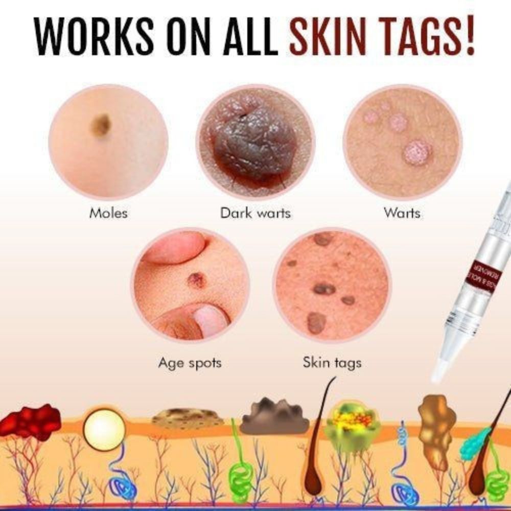 Tags & Moles Remover | Filindra
