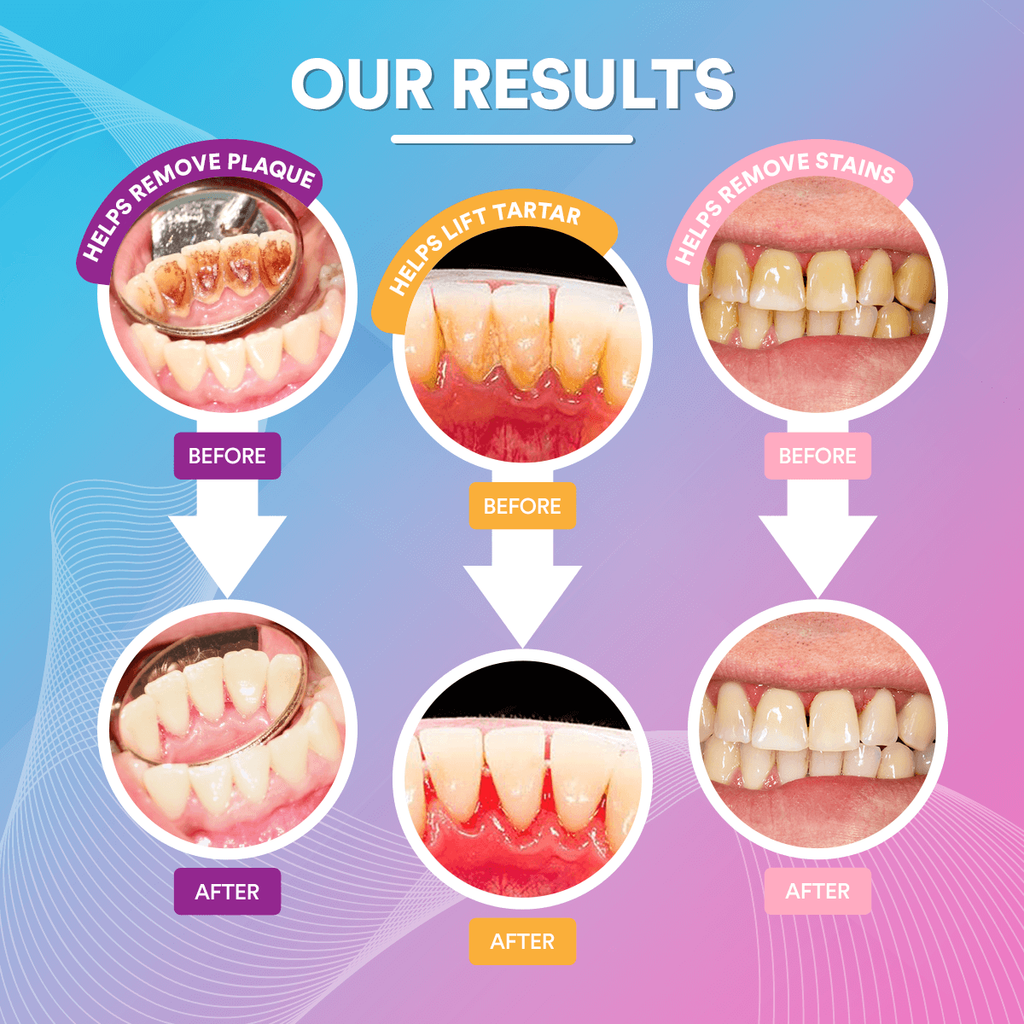 Elite Smile Technology prémium szónikus fogtisztító — professzionális szájápolási eszköz