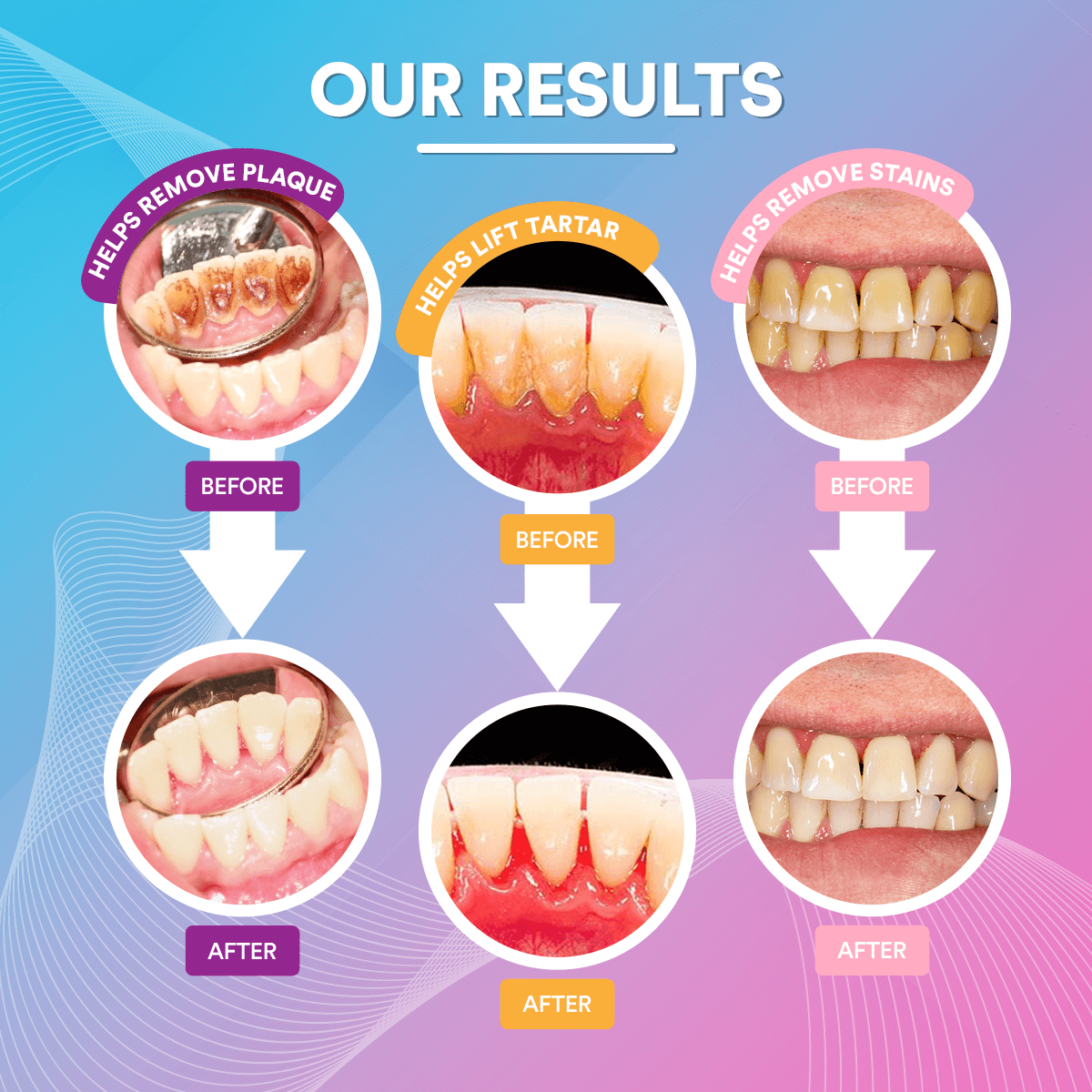 Elite Smile Technology prémium szónikus fogtisztító — professzionális szájápolási eszköz