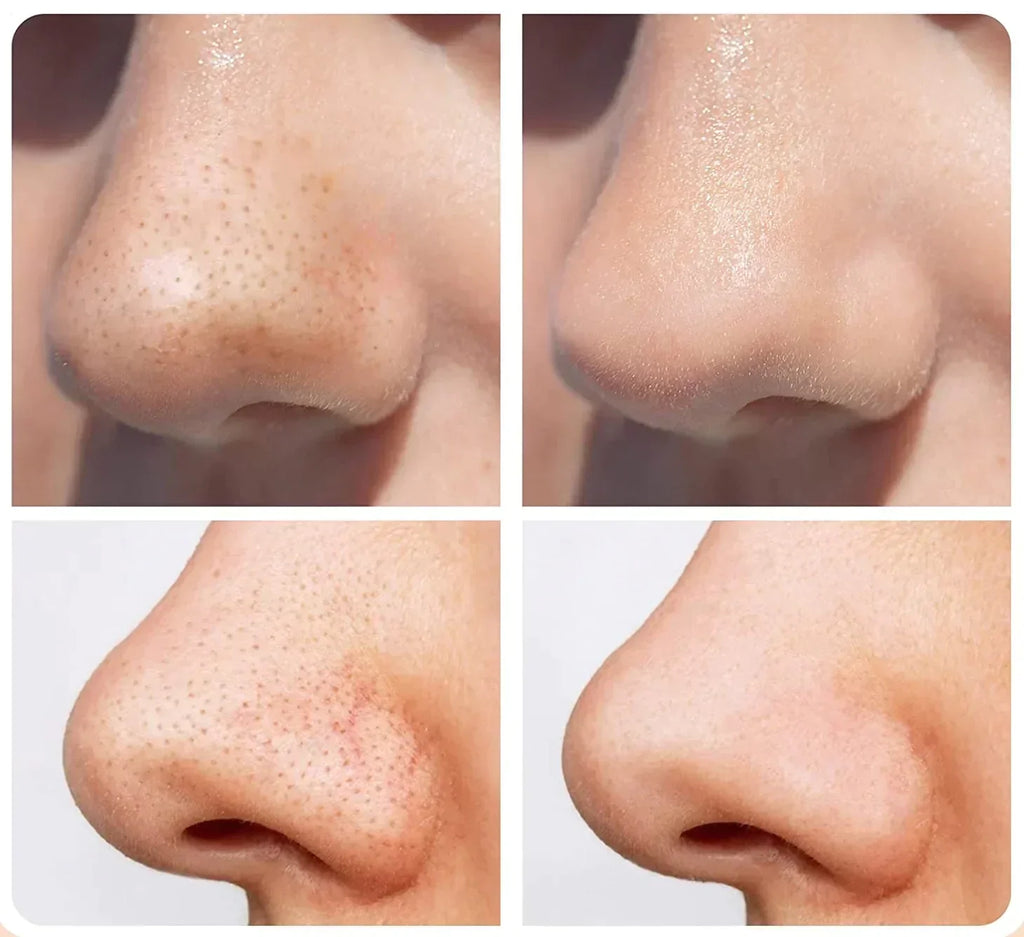 Comforth MicroDerm Diamantschleifer — Hauterneuerung und Mitesserpflege