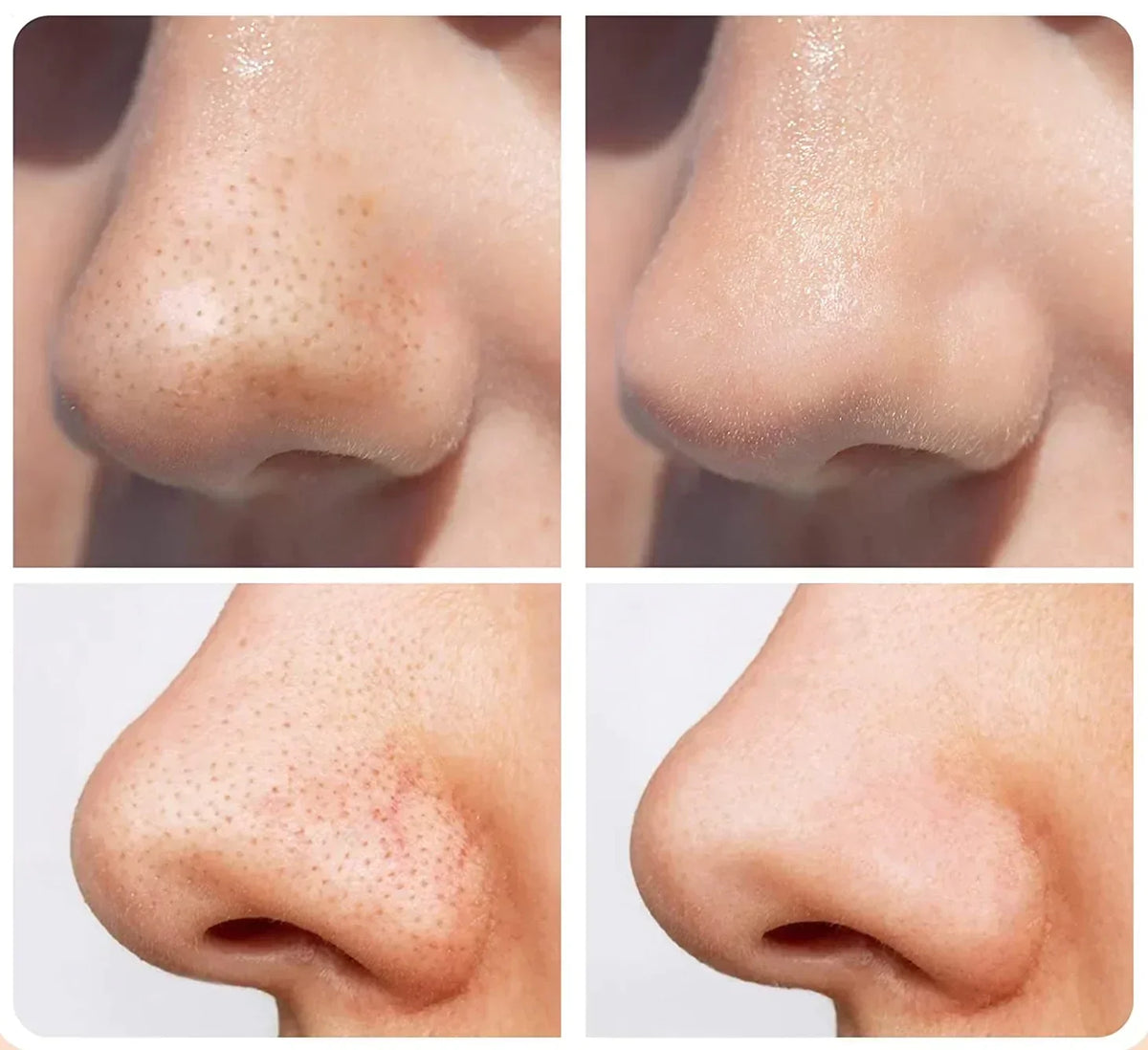 Comforth MicroDerm Diamantschleifer — Hauterneuerung und Mitesserpflege