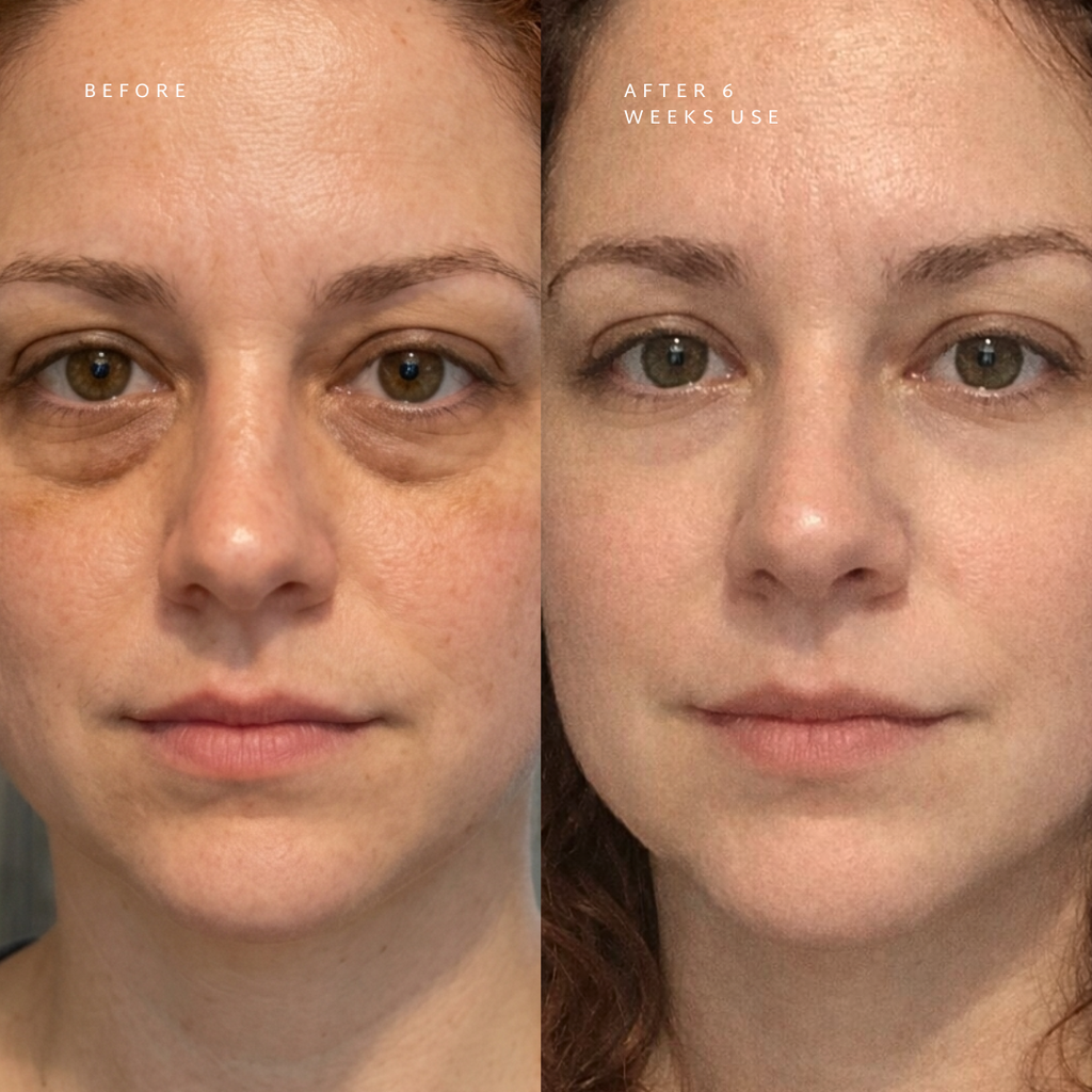 Dual-Tech Under Eye Rejuvenation Device — Red Light And EMS Therapy