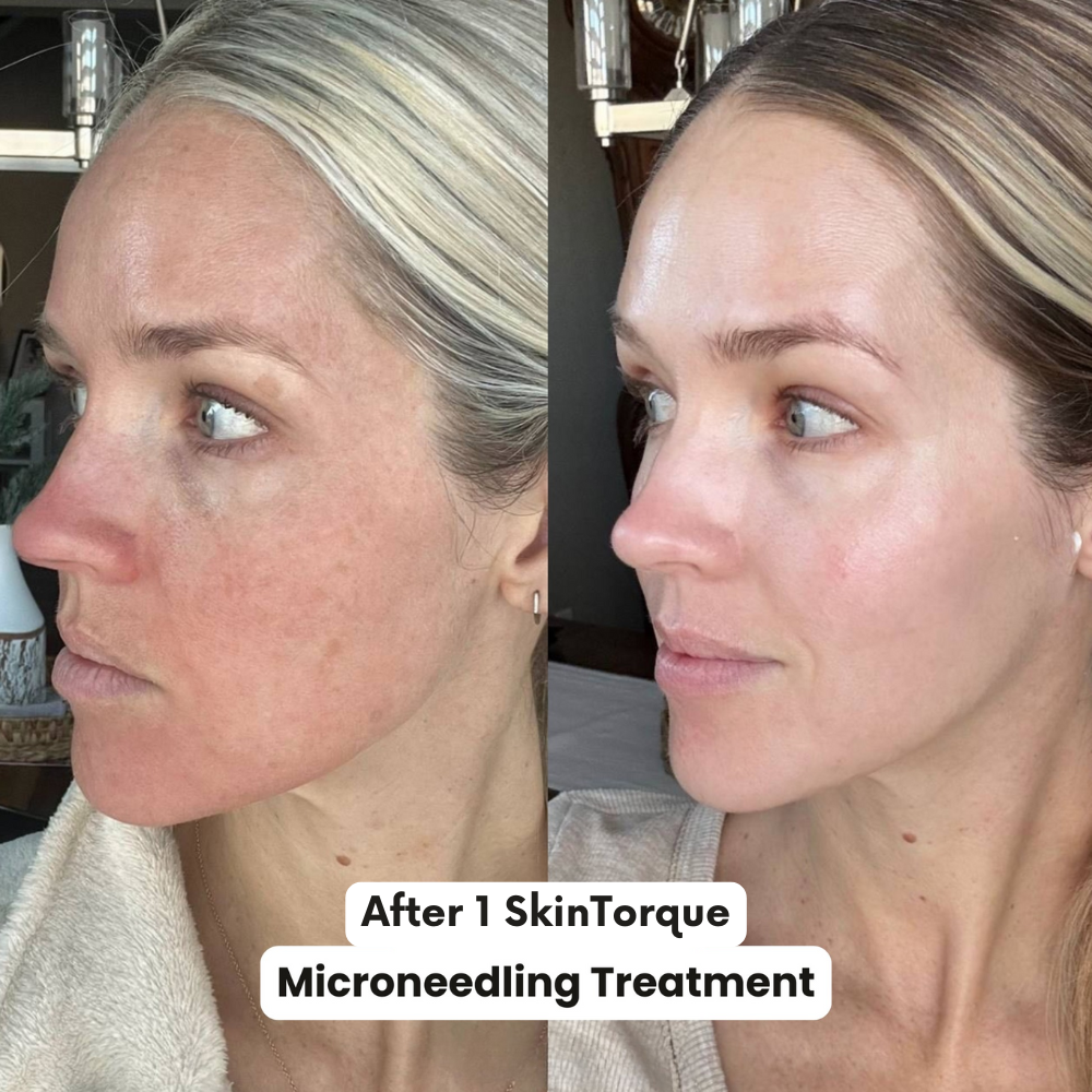 Bolígrafo de cartucho de espiral nano — dispositivo de microneedling con microcanales
