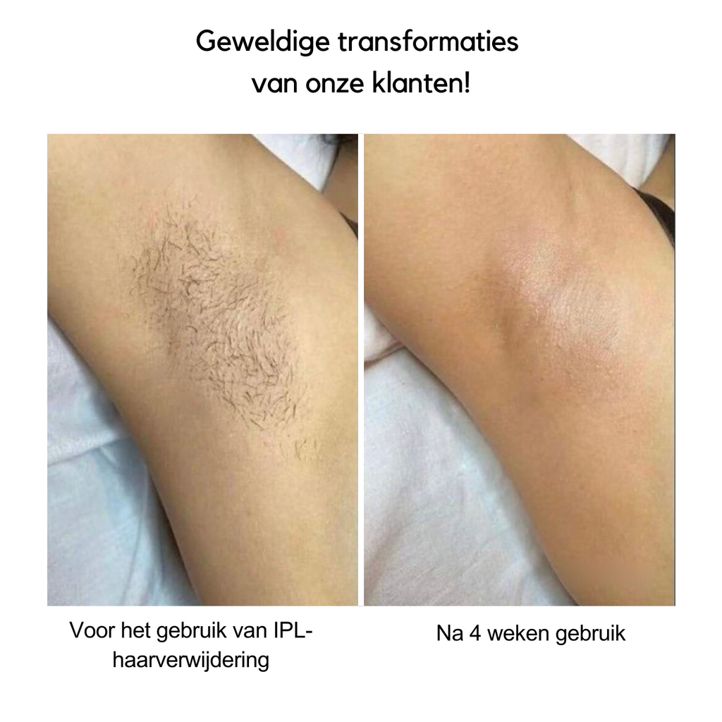 IPL-Haarentfernungsgerät — Fortschrittliche Licht-Haarentfernung
