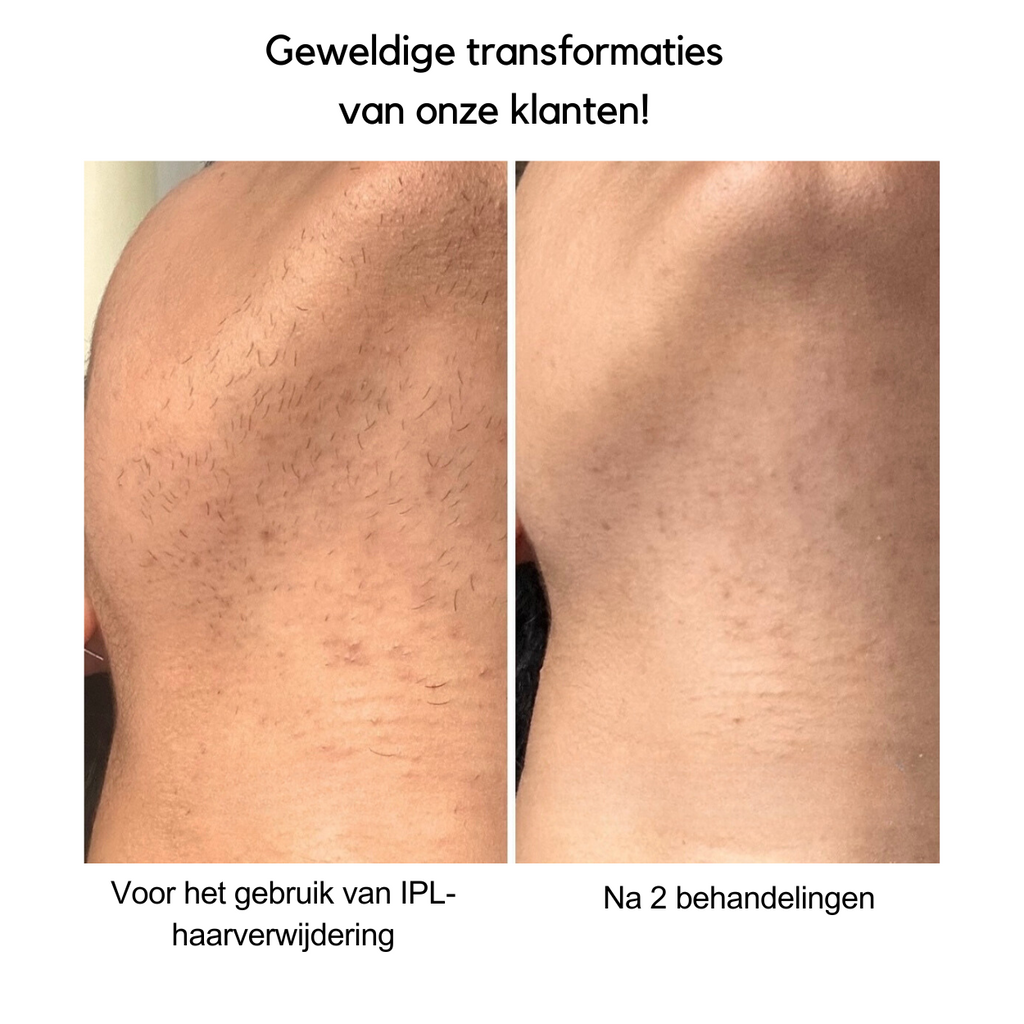 IPL-Haarentfernungsgerät — Fortschrittliche Licht-Haarentfernung