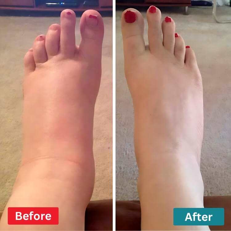 Συσκευή μασάζ ποδιών NMES Feet Relive για ανακούφιση από τον νευροπαθητικό πόνο