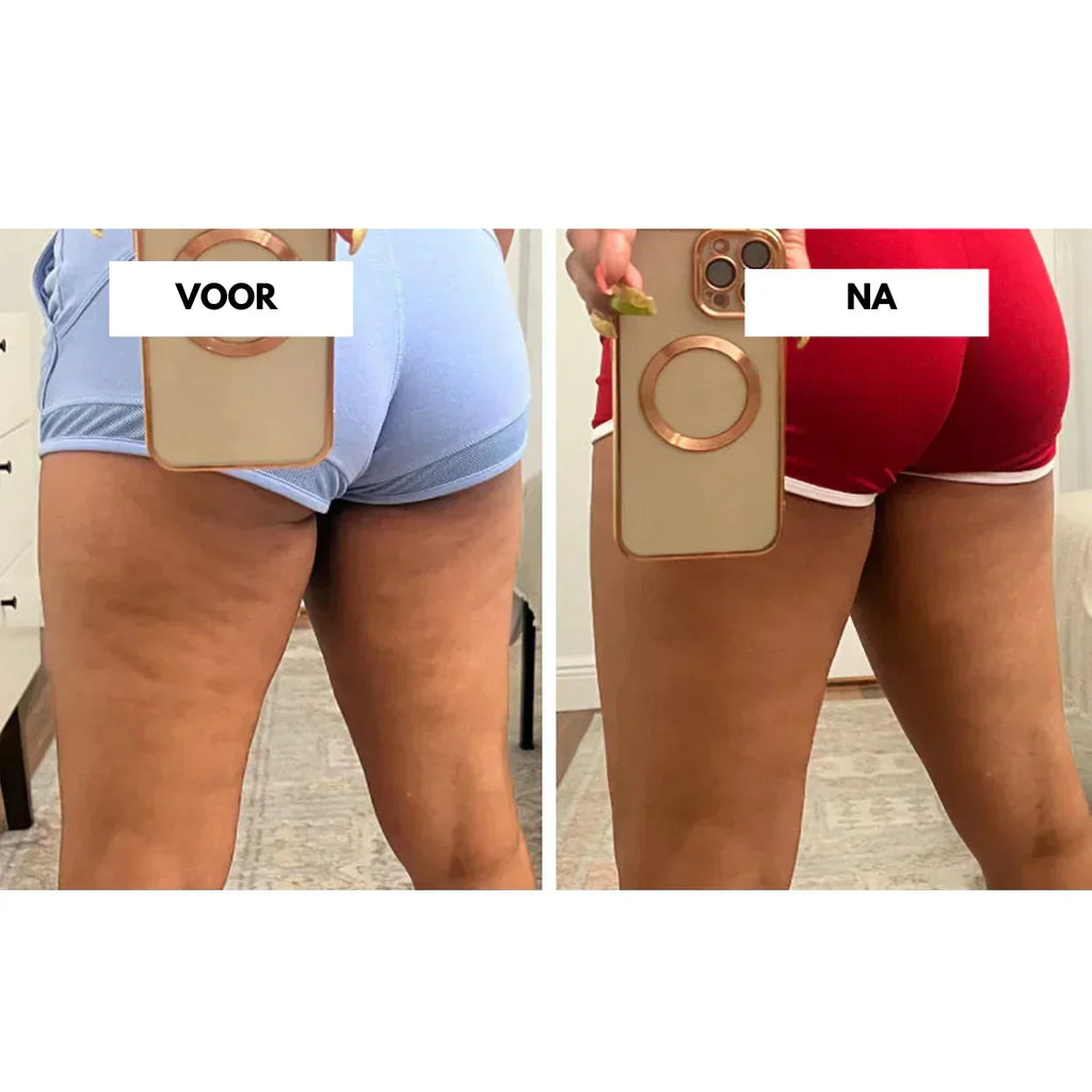 CelluLift Anti-Cellulite-Vakuummassagegerät für straffere Haut