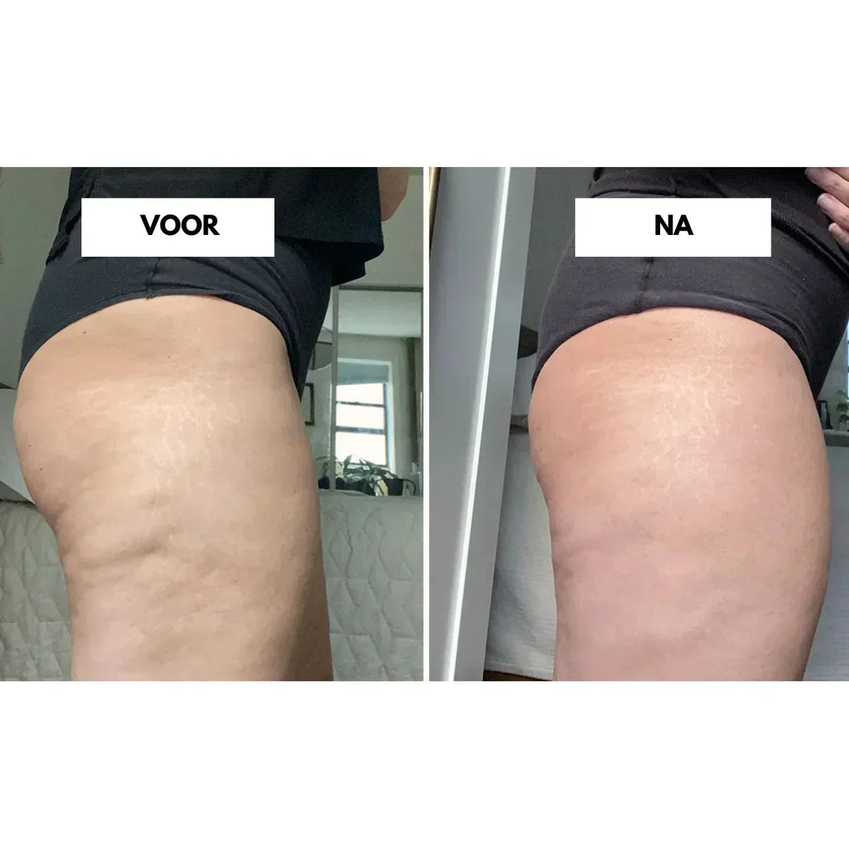 CelluLift Anti-Cellulite-Vakuummassagegerät für straffere Haut
