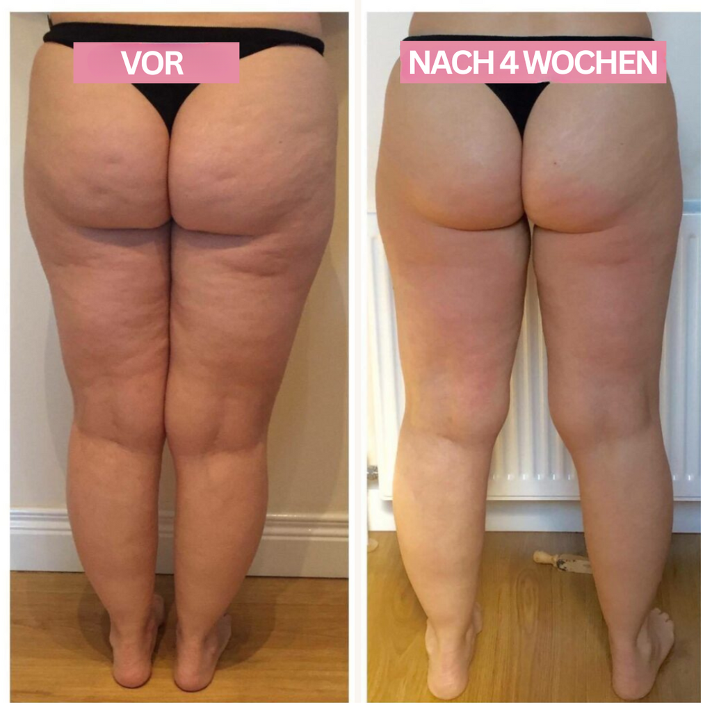 Slimcupp Anti-Cellulite-Schröpfgerät — Infrarottherapie