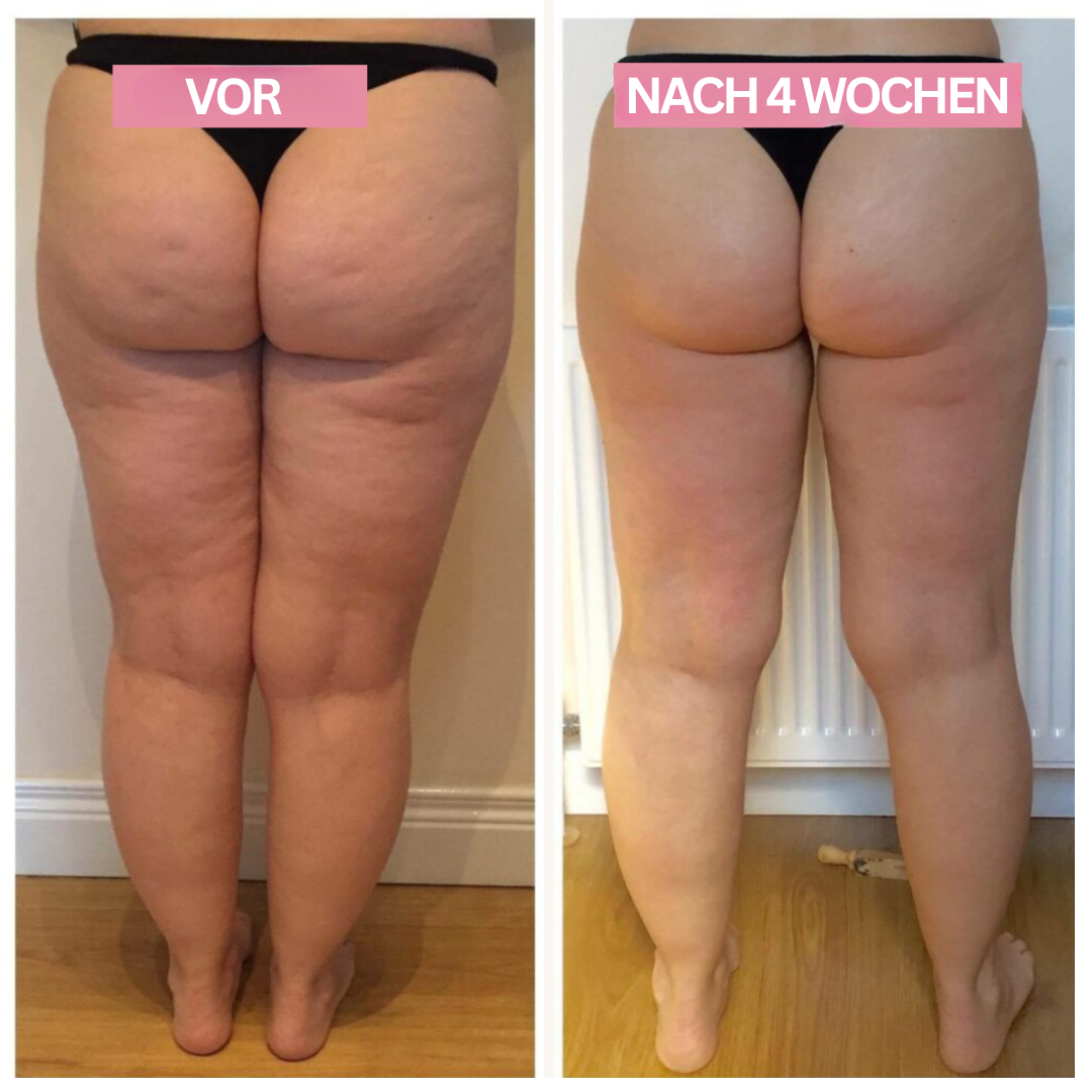 Slimcupp Anti-Cellulite-Schröpfgerät — Infrarottherapie