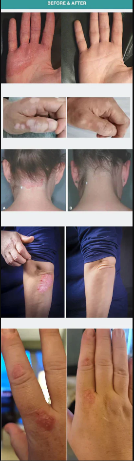 Luz de terapia UVB de 308 nm: tres pantallas de lámpara independientes, inalámbrica y portátil