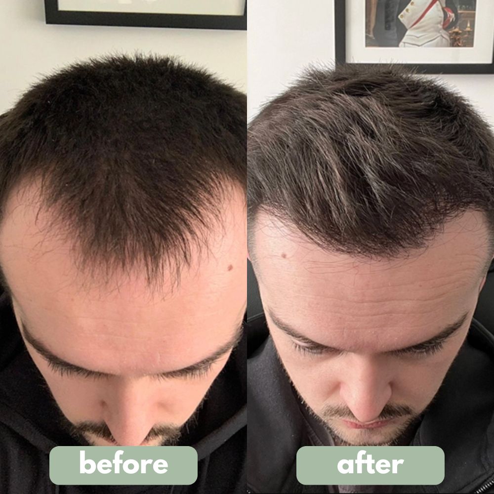 Pro-Growth Professional Hair Revitalizer — Precision Roll-On Applicator
