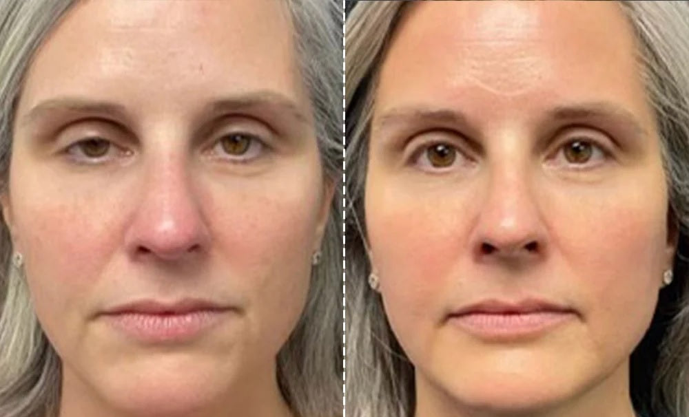 EMS Facial Toning and Lifting Mask — Hands-Free Skincare Device