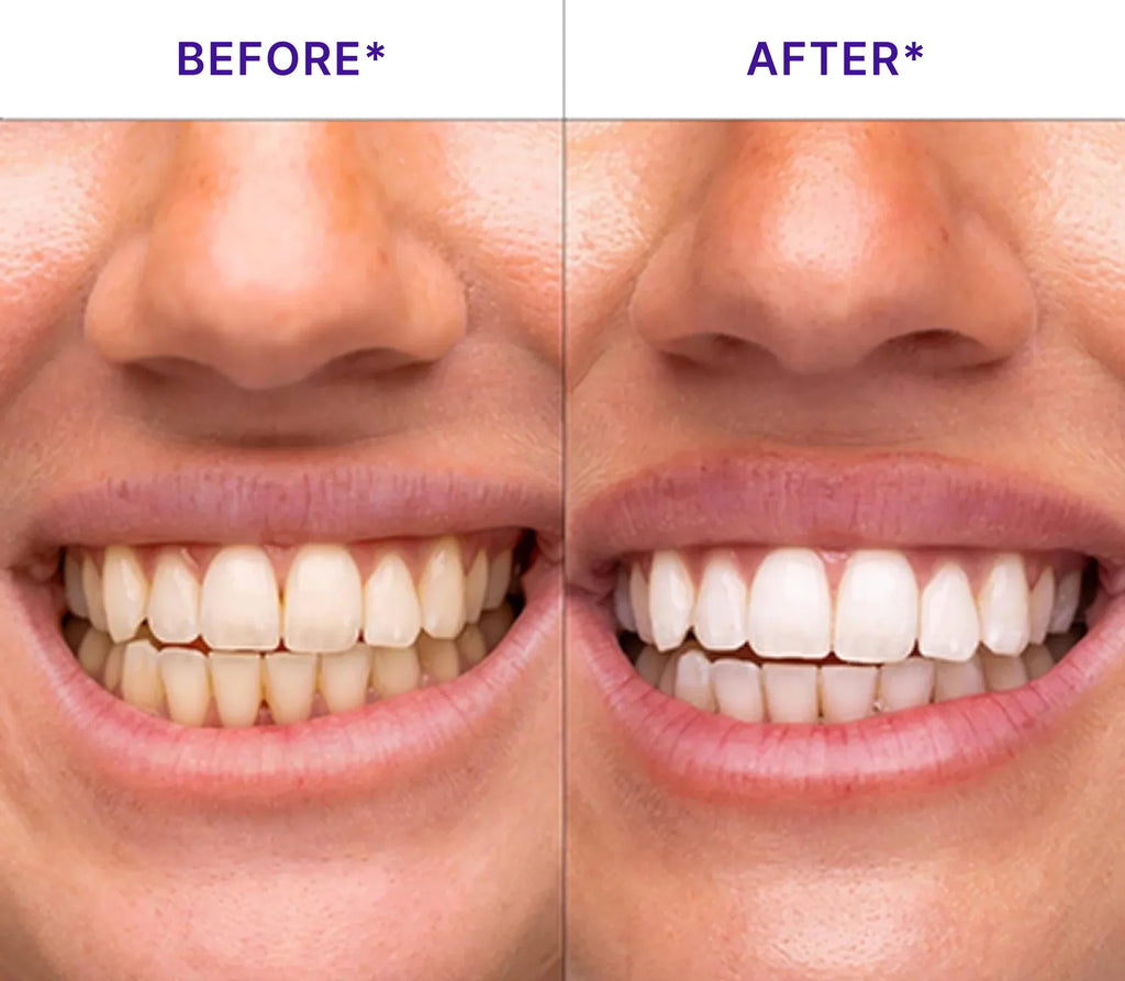 LumiSmile V34 Purple Teeth Whitening Strips — PAP+ Color Correction