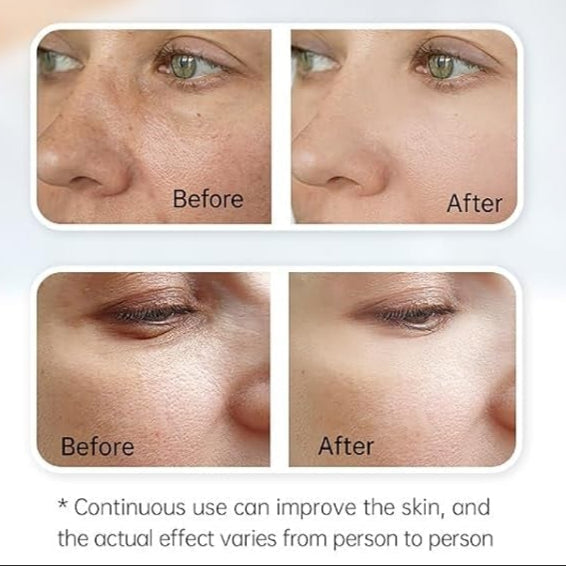 Avanceret Hydra H3-microneedlingpen — automatisk seruminfusion