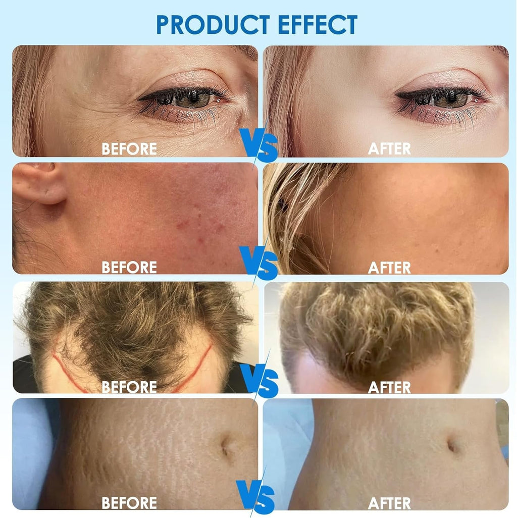 Avanceret Hydra H3-microneedlingpen — automatisk seruminfusion