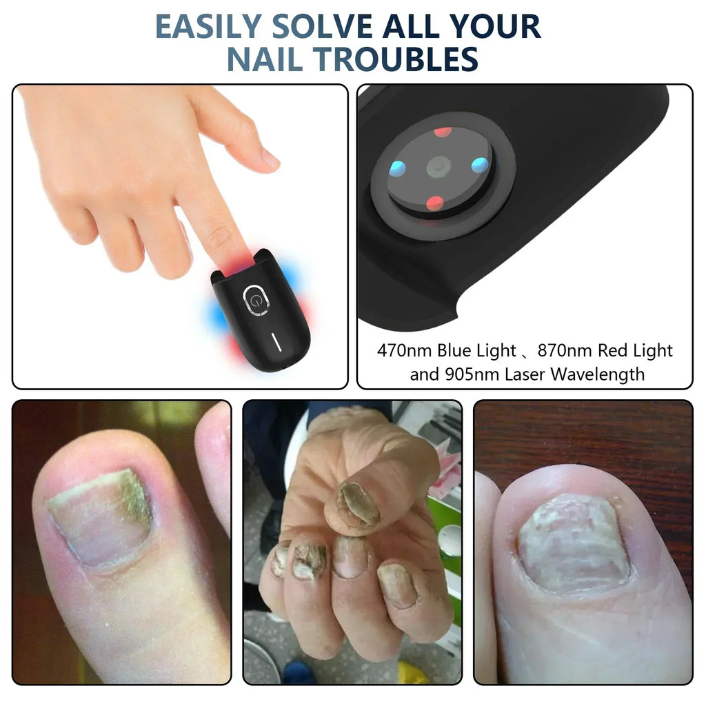 Anti-Fungal Toenail Laser Therapy Machine — Portable USB Charge