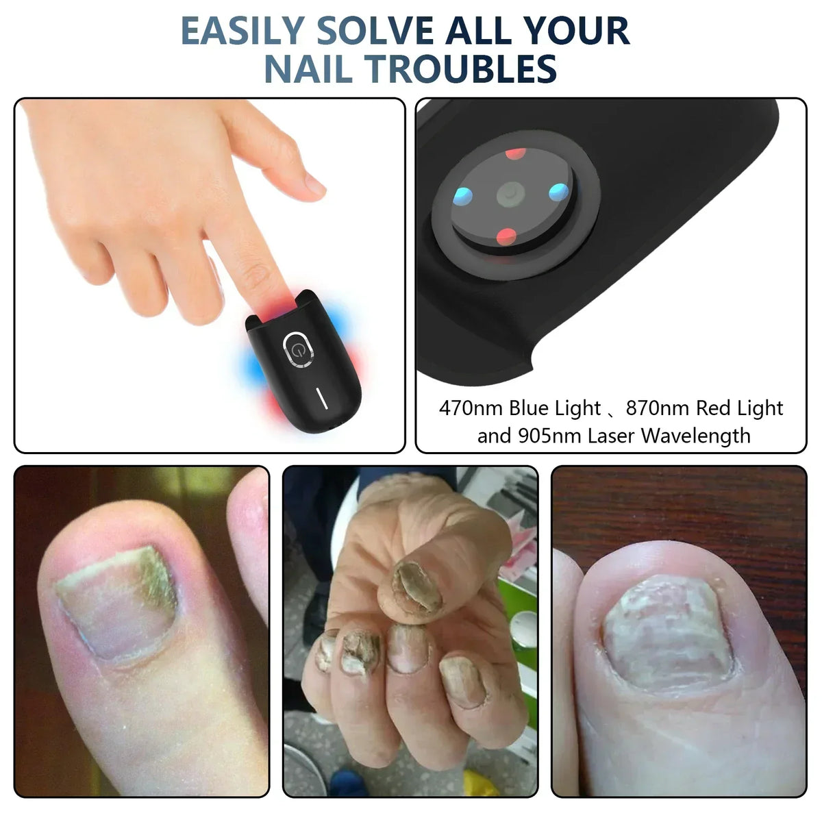 Anti-Fungal Toenail Laser Therapy Machine — Portable USB Charge