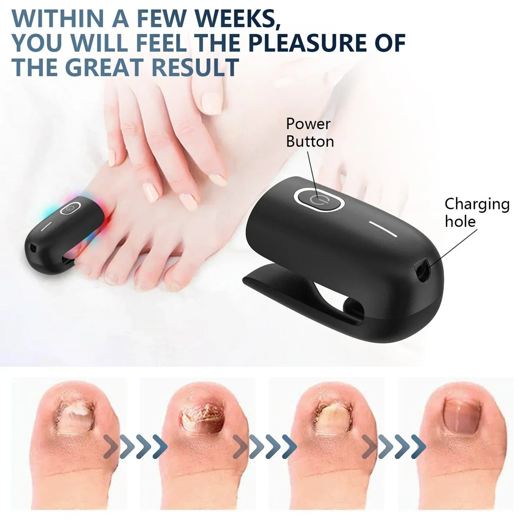 Anti-Fungal Toenail Laser Therapy Machine — Portable USB Charge