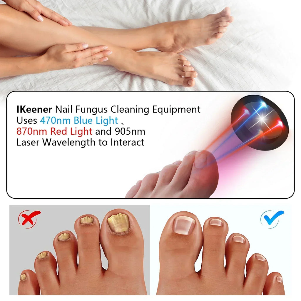 Anti-Fungal Toenail Laser Therapy Machine — Portable USB Charge