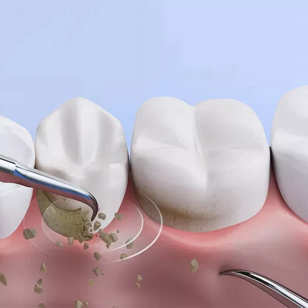 OralPro ultraljudsbaserad plackborttagare — verktyg för rengöring av tandsten och kalkavlagringar