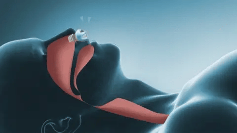 Cichy bezprzewodowy CPAP Lumenix Nano — kompaktowa konstrukcja gotowa do podróży