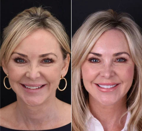 Facettes dentaires amovibles NovaBright pour dents supérieures et inférieures — sourire naturel instantané
