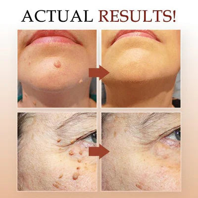 Tags & Moles Remover | Filindra
