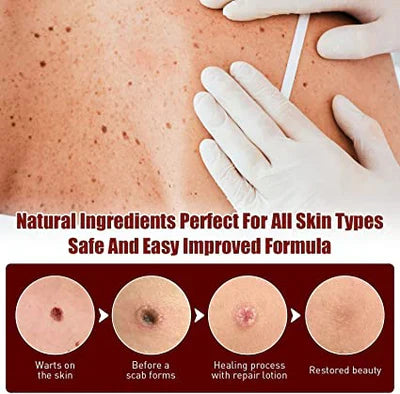 Tags & Moles Remover | Filindra