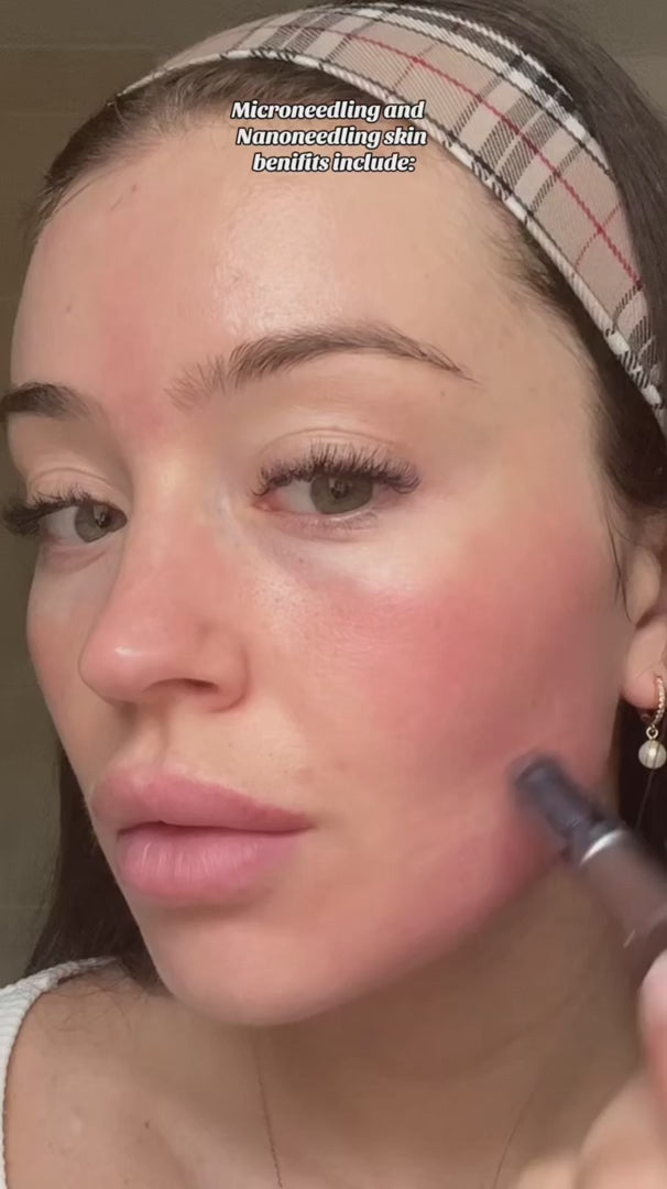 Bolígrafo de cartucho de espiral nano — dispositivo de microneedling con microcanales