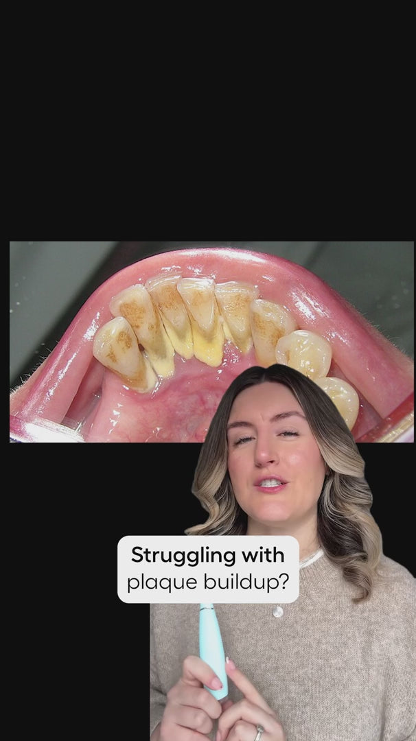 Elite Smile Technology prémium szónikus fogtisztító — professzionális szájápolási eszköz