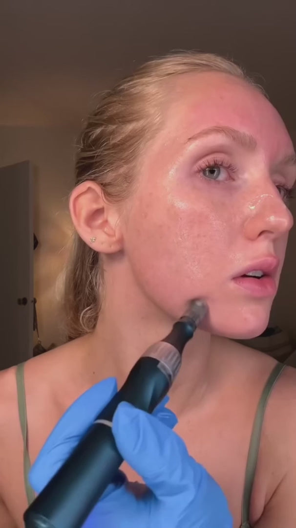 Bolígrafo de cartucho de espiral nano — dispositivo de microneedling con microcanales