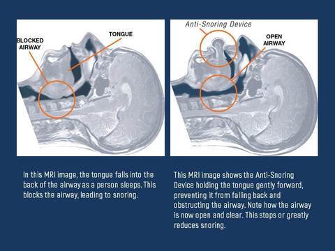 Apnea Tongue Stabilizing Device | Filindra