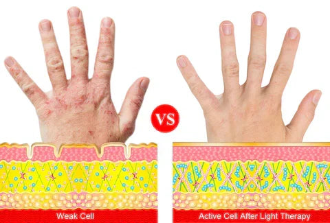 Red Light Therapy Arthritis Glove — Targeted Wavelength LEDs