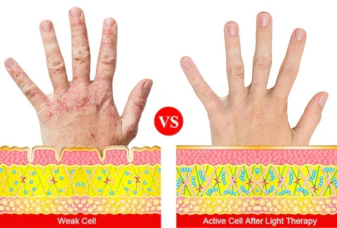 Rotlichttherapie-Handschuhe gegen Arthritis — Schmerzlinderung für Hände mit Nahinfrarot